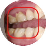 Molar Malocclusion Class II