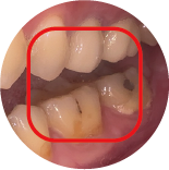 Molar Malocclusion Class III