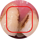 Tooth Discoloration