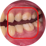 Crossbite