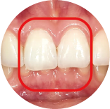 Deep Overbite