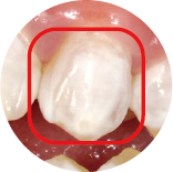 Demineralization