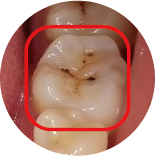 Dental Caries
