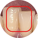 Dental Crowding