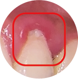 Gingivitis