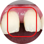 Interdental Space