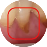 NCCL / Abfraction