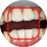 Open Bite