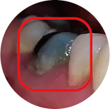Pulp Lesion