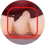 Tooth Torsion