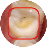Tooth Wear