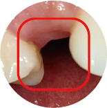 Tooth Loss